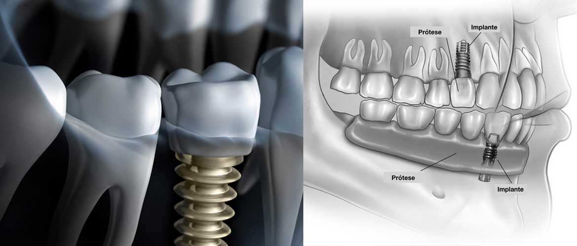 cirurgia--implante